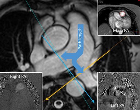 Cardiac Mri In Pulmonary Hypertension From Magnet To Bedside