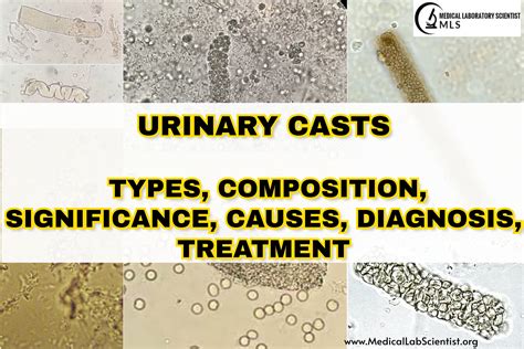 Casts In Urine Medical Laboratories