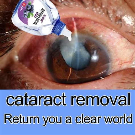 Cataract Eye Drops Eye Care Wash And Cleanse Your Eyes To Relieve Eye