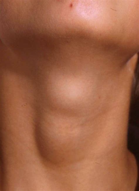 Causes And Treatments Of Lumps Neck Armpit Wrist More Youmemindbody