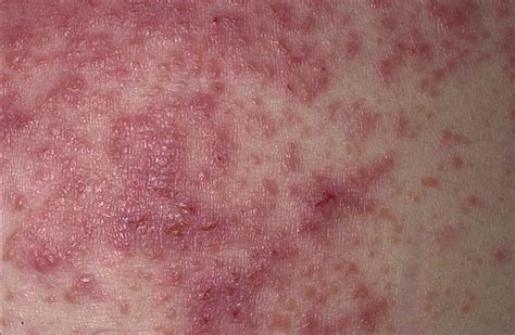 Celiac Rash Pictures