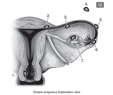 Ch 17 Sonographic Assessment Of The Ectopic Pregnancy Flashcards Quizlet