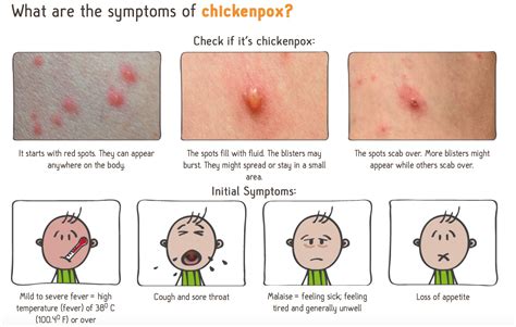 Chicken Pox Pictures Early Stages