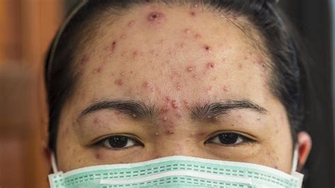 Chickenpox A Complete Guide To Symptoms Spread And More