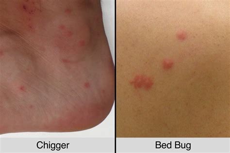 Chigger Bites Vs Bed Bug Bites How To Tell The Difference The Healthy