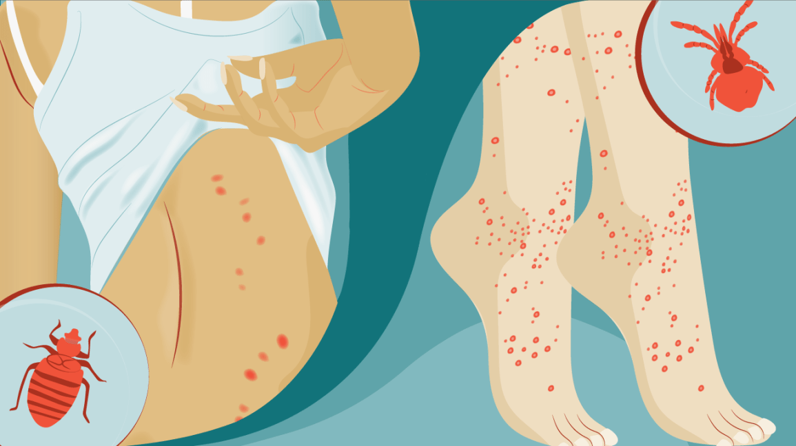 Chigger Bites Vs Bed Bug Bites How To Tell Them Apart