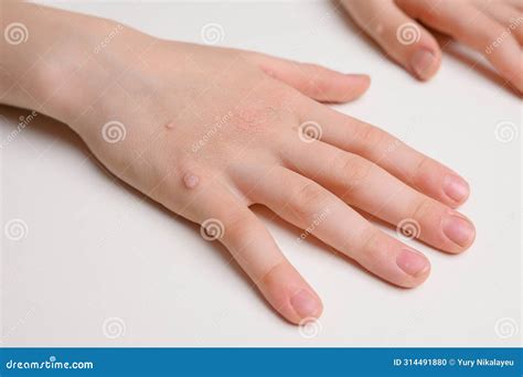 Child Hand With Common Viral Warts Verruca Vulgaris Flat Warts Close