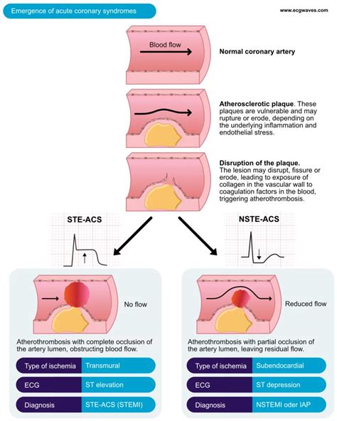 Classification Of Acute Coronary Syndromes Acs Acute Myocardial