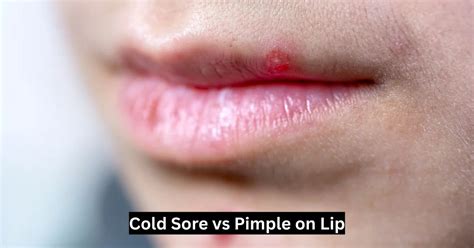 Cold Sore Or Pimple R Dermatologyquestions