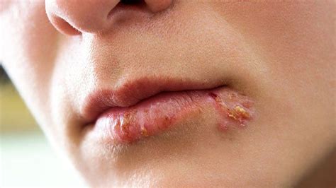 Cold Sore Symptoms And Diagnosis Christ Memorial