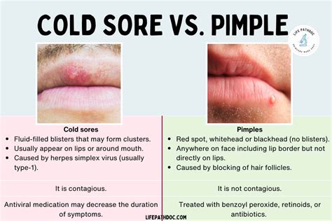Cold Sore Vs Pimple Differences Symptoms And Treatment