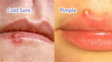 Cold Sore Vs Pimple How To Tell The Difference