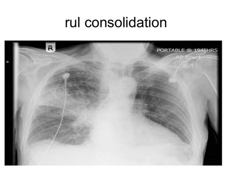 Collapse And Consolidation Lung Radiology