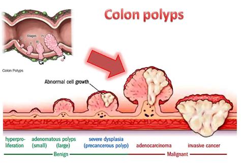 Colon Cancer Pictures Polyps