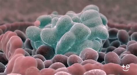 Colon Cancer Polyp Definition Doctorpedia Doctor Reviewed Video