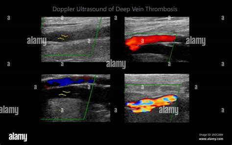 Color Doppler Ultrasound Determination In Deep Vein Thrombosis Patients
