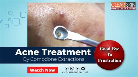 Comedone Extraction Acne Treatment Youtube