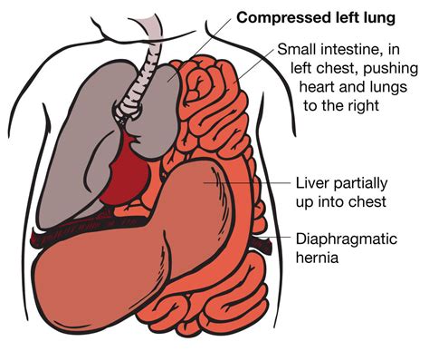 Congenital Diaphragmatic Hernia Cdh Ucsf Fetal Treatment Center