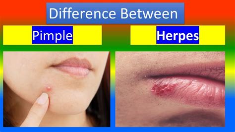Contrast Between Pimple And Herpes Youtube