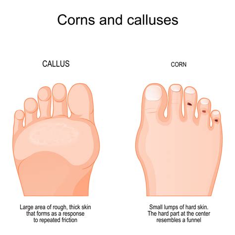 Corn Disease In Foot Pictures