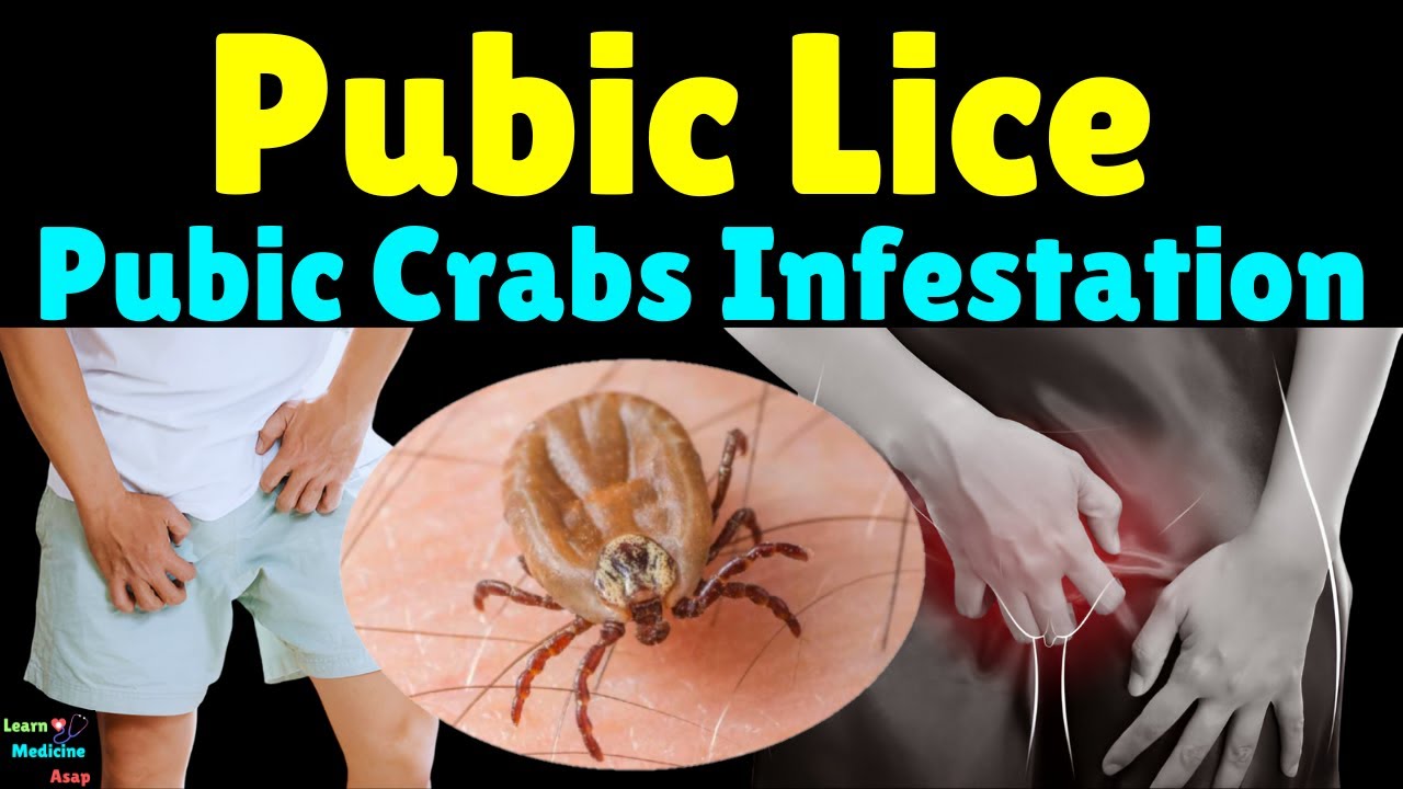 Crabs Std Pubic Lice Symptoms Treatment Of Pubic Lice Youtube