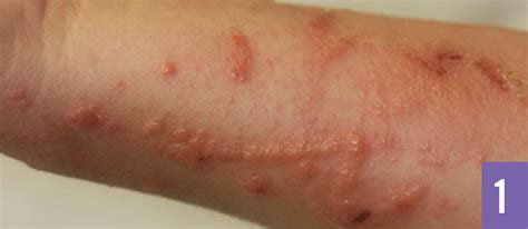Creeping Virginia Skin Rash