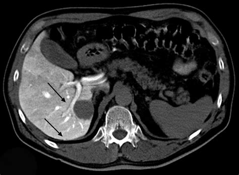 Ctap Ct During Arterial Portography In Locations Regional