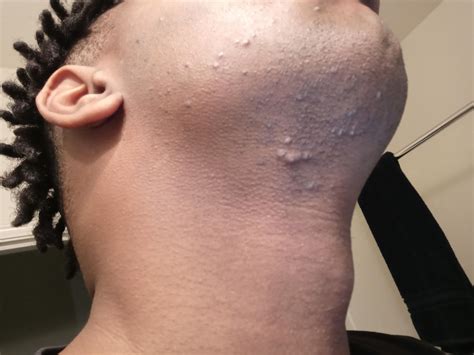 Cuteblackhair Hair Bumps On Neck