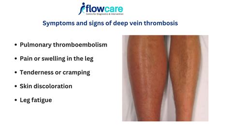 Deep Vein Thrombosis Dvt Warnings Signs Treatment