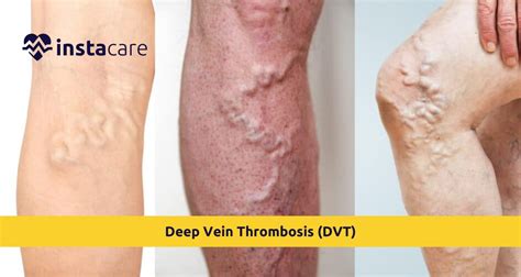 Deep Vein Thrombosis Dvt