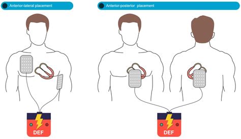 Defibrillator Pad Placement Where Do Electrode Pads Go