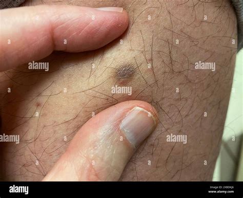 Dermatofibroma Pinch Test