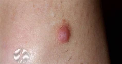 Dermnet Dermatofibroma Images