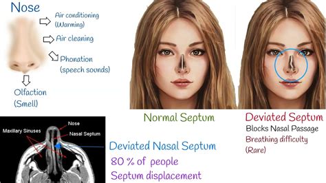 Deviated Septum Picture