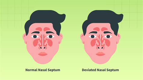 Deviated Septum Self Test