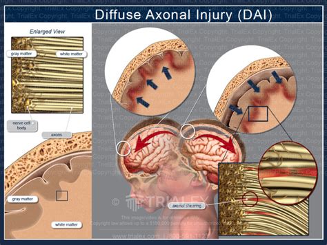 Diffuse Axonal Injury Dai Charlie Waters Law