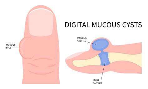 Digital Mucous Cyst Consultant360
