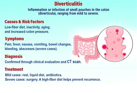 Diverticulitis Causes Symptoms And Treatments
