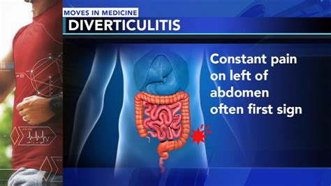 Diverticulitis Symptoms Back Pain And Treatment