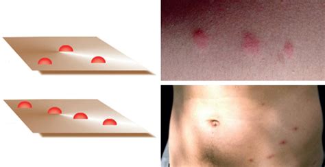 Do Fleas Bite In Clusters Of Three Fleascience