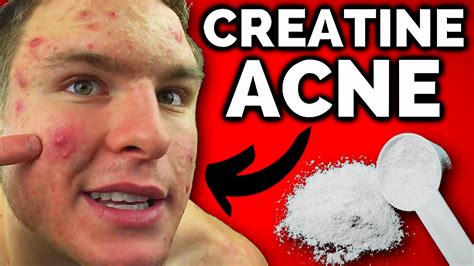 Does Creatine Cause Acne Clearing The Confusion Spartan Nutrition