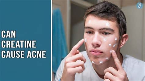 Does Creatine Cause Acne