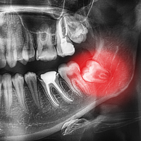 5 Wisdom Teeth Facts