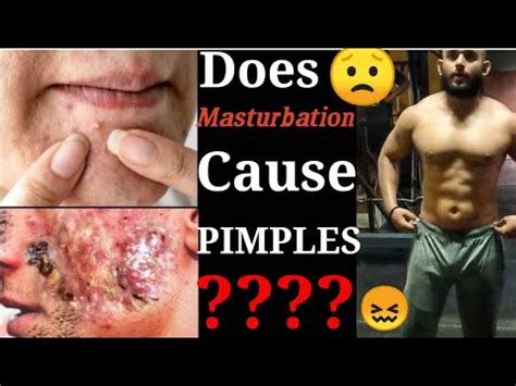 Does Masturbation Cause Pimples Pimples And Masturbation Relation