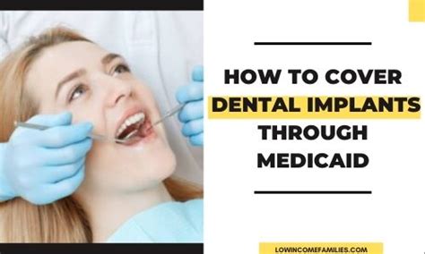 Does Medicaid Cover Dental Implants