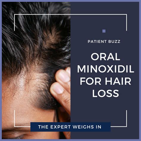 Does Minoxidil Cause Hair Loss