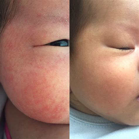 Download 37 Mild Eczema Rash On Baby Face