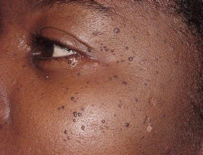 Dpn Medical Abbreviation