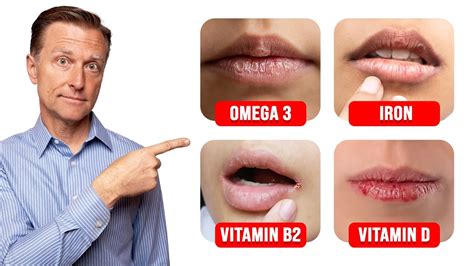Dry Lips Vitamin Deficiency