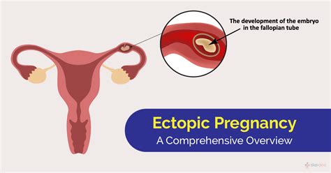 Ectopic Pregnancy